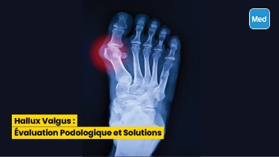 Hallux Valgus : Évaluation Podologique et Solutions