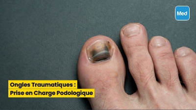 Ongles Traumatiques : Prise en Charge Podologique