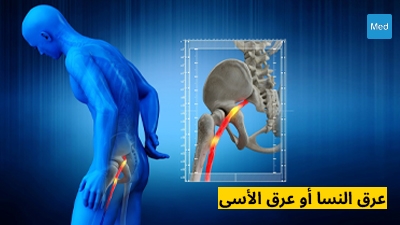 عرق النسا أو عرق الأسى