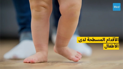 الأقدام المسطحة لدى الأطفال