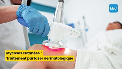 Mycoses cutanées : Traitement par laser dermatologique