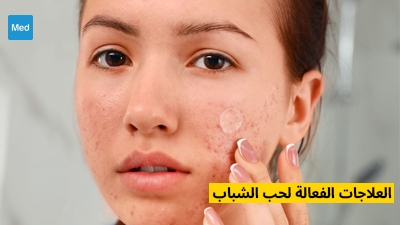 العلاجات الفعالة لحب الشباب