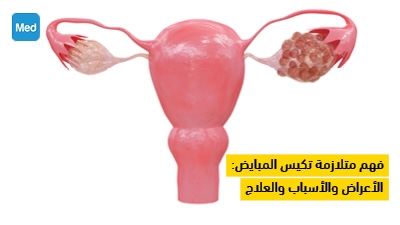فهم متلازمة تكيس المبايض: الأعراض والأسباب والعلاج