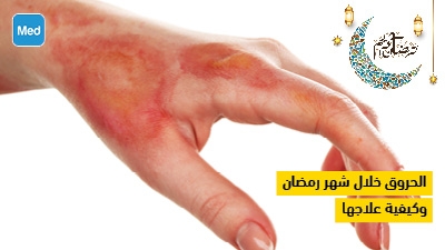 الحروق خلال شهر رمضان وكيفية علاجها