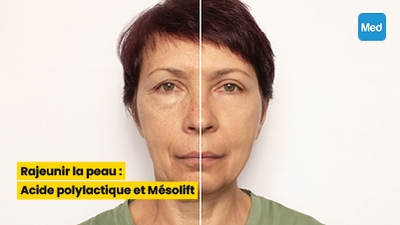 Rajeunir la peau : Acide polylactique et Mésolift