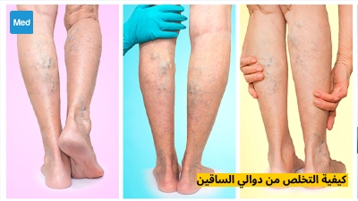كيفية التخلص من دوالي الساقين