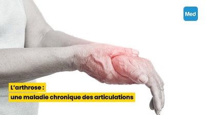 L'arthrose : une maladie chronique des articulations