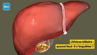 Lithiase biliaire : quand faut-il s