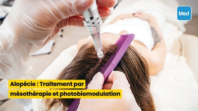 Alopécie : Traitement par mésothérapie et photobiomodulation