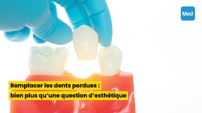 Remplacer les dents perdues : bien plus qu