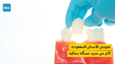 تعويض الأسنان المفقودة : أكثر من مجرد مسألة جمالية