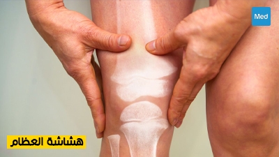 هشاشة العظام