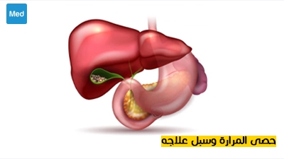 حصى المرارة وسبل علاجه