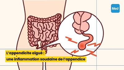 L'appendicite aiguë : une inflammation soudaine de l'appendice