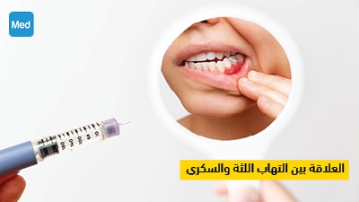 العلاقة بين التهاب اللثة والسكري