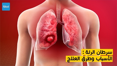 سرطان الرئة : الأسباب وطرق العلاج
