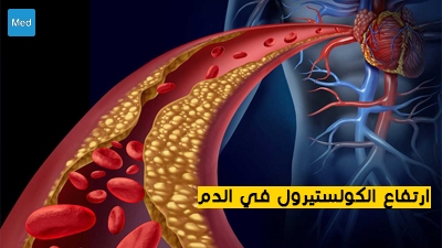ارتفاع الكولستيرول في الدم