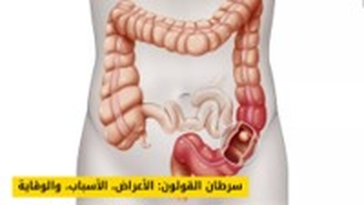 سرطان القولون: الأعراض، الأسباب، وكيفية الوقاية والتشخيص المبكر