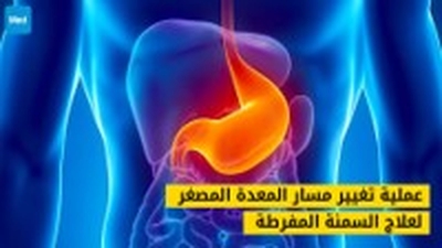 عملية تغيير مسار المعدة المصغر لعلاج السمنة المفرطة