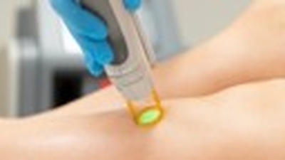 L’Épilation Laser – Une Solution Durable pour une Peau Lisse