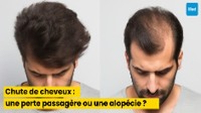 Chute de cheveux : comment distinguer une perte passagère d’une alopécie ?