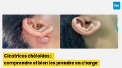 Cicatrices chéloïdes : comprendre et bien les prendre en charge
