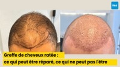 Greffe de cheveux ratée : ce qui peut être réparé, ce qui ne peut pas l'être