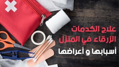 علاج الكدمات الزرقاء في المنزل .. وأسبابها وأعراضها
