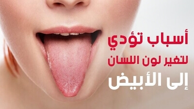 أسباب تؤدي لتغير لون اللسان إلى الأبيض