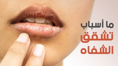 ما أسباب تشقق الشفاه