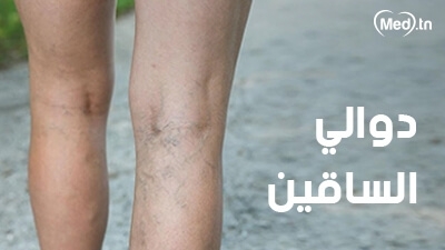 دوالي الساقين