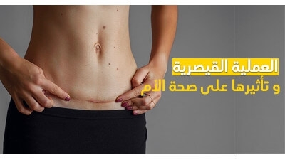 العملية القيصرية و تأثيرها على صحة الأم