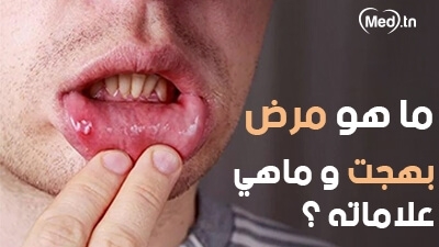 ماهو مرض بهجت و ماهي علاماته ؟