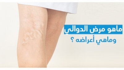 ماهو مرض الدّوالي وماهي أعراضه ؟
