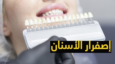 إصفرار الأسنان