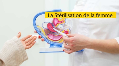 La Stérilisation de la femme 