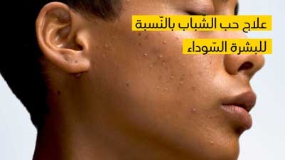  علاج حب الشّباب بالنّسبة للبشرة السّوداء 