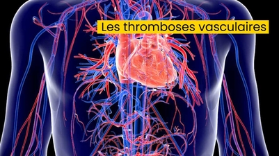 Les thromboses vasculaires