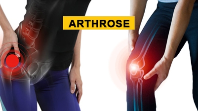 Arthrose