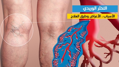 التخثر الوريدي : الأسباب ، الأعراض وطرق العلاج