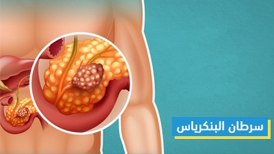 سرطان البنكرياس 