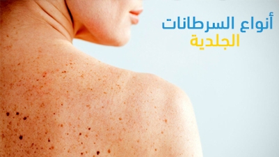 أنواع السرطانات الجلدية