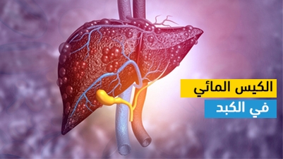 الكيس المائي في الكبد
