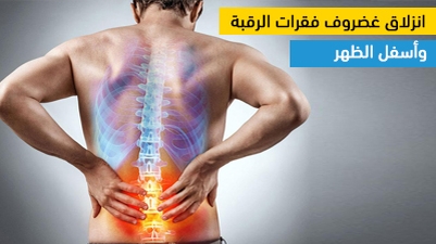 انزلاق غضروف فقرات الرقبة وأسفل الظهر