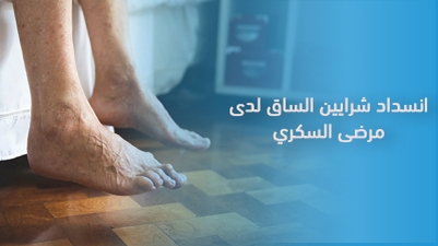 انسداد شرايين الساق لدى مرضى السكري