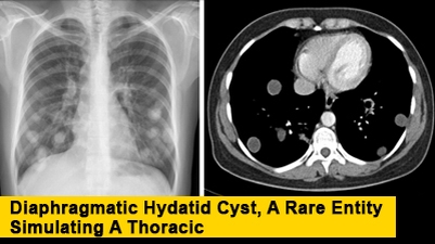 Diaphragmatic Hydatid Cyst, A Rare Entity Simulating A Thoracic