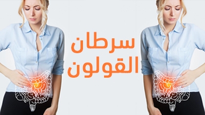 سرطان القولون