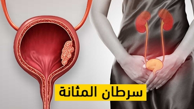 سرطان المثانة