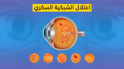 اعتلال الشبكية السكري