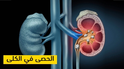 الحصى في الكلى